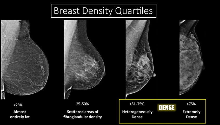 Breast density quartiles