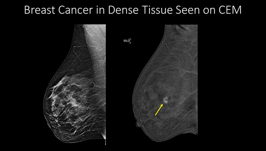 Breast cancer in dense tissue seen on CEM