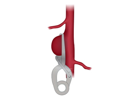 Diagram depicting clipping for stroke treatment
