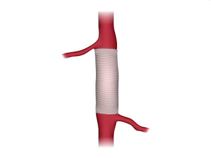 Diagram depicting an open repair for stroke treatment