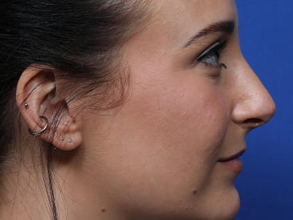 Rhinoplasty by Dr. Humphrey – Post-Op