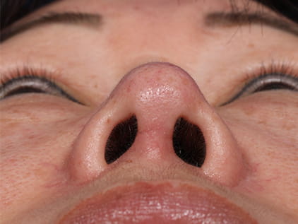 Rhinoplasty by Dr. Humphrey – Post-Op