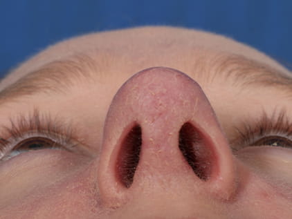 Average nose job cost | Johnson County, Kansas City