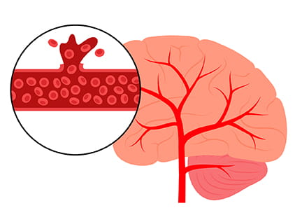 Stroke Signs & Treatments | The University of Kansas Health System