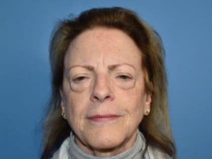 Before plastic surgery procedure